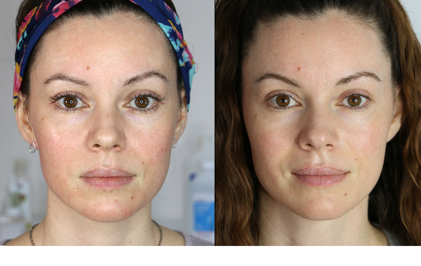 beforeafterdermapen