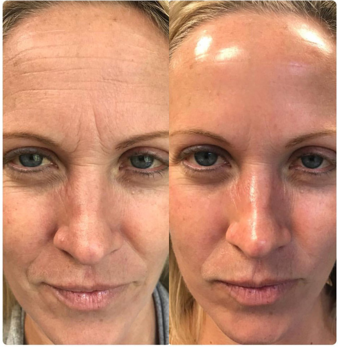 hydrafacial 2